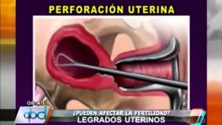 PROCREAR ¿Los legrados uterinos afectan la fertilidad [upl. by Lannie]