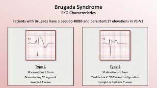 Advanced EKGs  Sudden Cardiac Death Hypertrophic cardiomyopathy ARVD Brugada syndrome and CPVT [upl. by Garrick155]