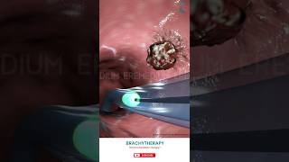 Know About Brachytherapy ↪ 3D Medical Animation Brachytherapy InternalRadiationTherapy [upl. by Otsenre]