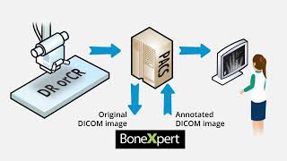 Bone age automated with BoneXpert AI  precise and easy [upl. by Eiramanig]