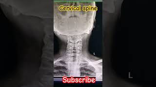 Cervical spine AP lateral Xray shorts viral medical student trending support me [upl. by Victorie]