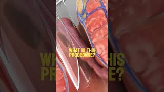 What is this procedure Video credit Prof Dr Sedat Belli YouTube Thanks for this video [upl. by Jaela]