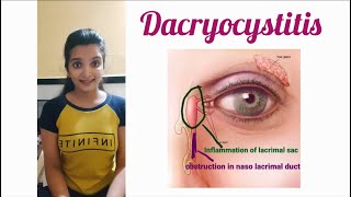 Dacryocystitis Part1 congenital Dacryocystitis  AK Khurana [upl. by Steere493]