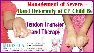 Hand Deformity of Cerebral Palsy Child Treatment By Tendon Transfer and Therapy  Trishla Foundation [upl. by Ahsuatan]