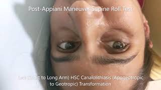 Transformation of Apogeotropic Horizontal Canal BPPV to Geotropic Variant [upl. by Nnylacissej]