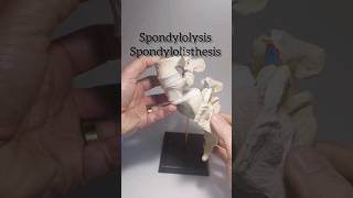 Spondylolysis Spondylolisthesis Dynamic Disc Designs Model [upl. by Alicirp433]