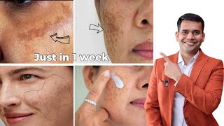 Pigmentation Melasma Dark Spot 100 Working Treatment  Dr Vivek Joshi [upl. by Schuyler]