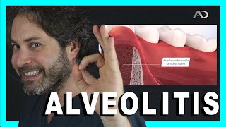 🌡️ALVEOLITIS SECA CAUSAS Y SOLUCIONES🥵Infeccion después de SACAR una MUELA [upl. by Ardnaz]