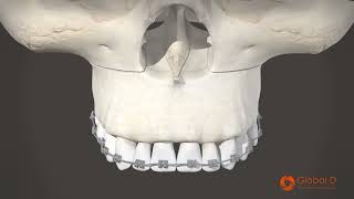 Osteotomie du sens transversal v1 1 FR [upl. by Janine]