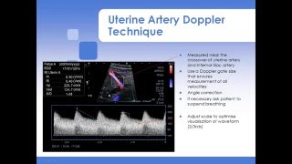 Advanced Fetal Doppler Webinar with Piotr Niznik [upl. by Cleon]