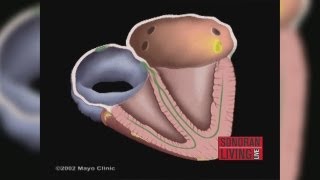 The Mayo Clinic explains how to treat Atrial Fibrillation [upl. by Thorma]