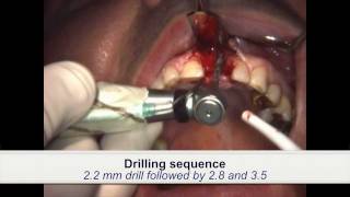 Dental Implant Placement in patient treated with iv bisphosphonates [upl. by Bik]