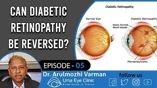 Diabetes Retinopathy  Can Diabetic Retinopathy Be Reversed  Dr Arulmozhi Varman  EPI 05 [upl. by Ushijima92]