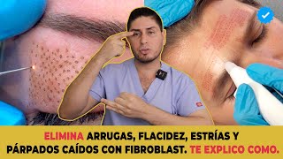 Levantamiento de párpados SIN CIRUGIA  Fibroblast  DOCTOR LEMUS [upl. by Eatnuhs]