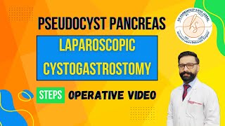 Laparoscopic Cystogastrostomy  Pseudocyst Pancreas  HD  Pancreatitis [upl. by Jerroll]