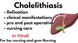 Cholelithiasis [upl. by Airebma]