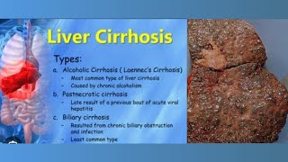 hepatic cirrhosis  liver cirrhosis testimony [upl. by Entwistle98]