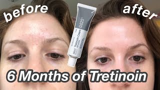 6 Month TretinoinRetinA Update Before amp After  My Current Skincare Routine [upl. by Eenwahs950]