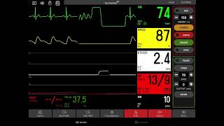 Ventricular Fibrillation with Defibrillation [upl. by Assetan891]