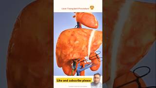 Liver transplant procedure animation vedio shorts [upl. by Bowerman526]