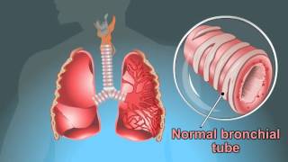 what are the Symptoms Of Tuberculosis [upl. by Graeme]