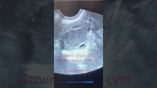 Endometriosis infertilityChochlate ovary cyst treatmenttrendingshorts viralsongendometriosisivf [upl. by Enyawud]