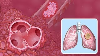 Understanding NonSmall Cell Lung Cancer [upl. by Latrena]