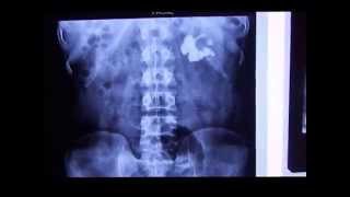 Intravenous Pyelogram  Intravenous Nephrogram  Intravenous Pyelography IVP in Staghorn Calculus [upl. by Yhtomiht]