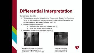 Idiopathic Osteosclerosis [upl. by Cosetta]