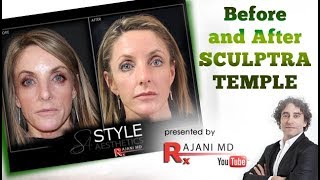 Watch Sculptra Injected Temples  Before and After Sculptra [upl. by Ahterahs]