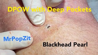 The Blackhead with deep pockets DPOW blackhead pearl extraction on posterior “popliteal” knee [upl. by Fiorenza693]