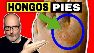 HONGOS EN LOS PIES CÓMO ELIMINARLOS SÍNTOMAS Y CAUSAS PIE DE ATLETA [upl. by Aerdnaek]