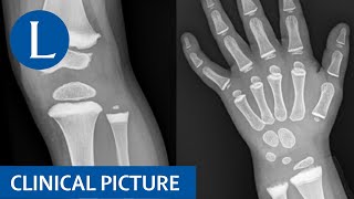 Metaphyseal sclerosis in a child with a giant cell tumour treated with denosumab [upl. by Eamon800]