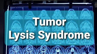 Tumor Lysis Syndrome [upl. by Krakow]