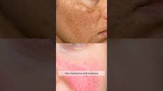 Steaming For Face  Yes or No  Dr Akriti Gakhar  Dermatologist tips shorts trending skincare [upl. by Dlawso480]