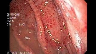 ENDOSCOPIA GASTRITIS EROSIVA [upl. by Bunny487]