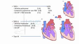 Atresia tricuspidea [upl. by Einhpad981]