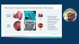 Rhinosinusitis With Nasal Polyps From Pathophysiology to Management [upl. by Naillik145]