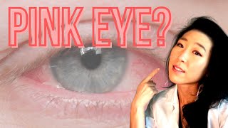 How Do I Know If I Have Pink Eye  Common Causes Of Pink Eyes [upl. by Rafaj]