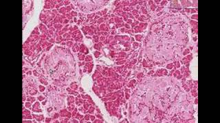 Histopathology Pancreas Type 2 Diabetes mellitus [upl. by Leonor]