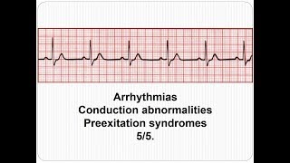 ECG Arrhythmias  Preextation syndromes 55 [upl. by Davin321]