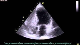 RENDU OSLER DISEASE  FISTULA  POSTIVE CONTRAST ECHO [upl. by Grimbal]