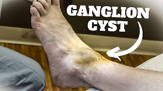 HUGE Ankle Ganglion Cyst Aspiration Surgery  Foot amp Ankle Treatment [upl. by Yerroc810]