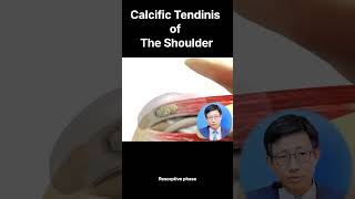 Understanding Calcific Tendinitis Stages Symptoms and Treatment Options 석회성 건염의 이해 단계 증상 및 치료 방법 [upl. by Riccio145]