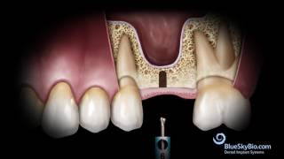 Basic Hammerless Sinus Lift Instrument Technique [upl. by Iaras]