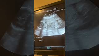 23 weeks pregnancy ultrasound pregnancy pregnancytips baby ultrasound pregnancycare [upl. by Kellene514]