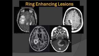 Brain Scans Lord of the Ring Enhancing Lesions 101 [upl. by Allan223]