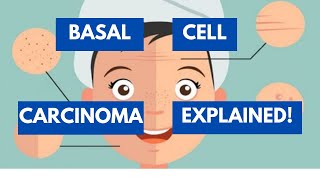 Ultimate Lecture For Everything about Basal Cell Carcinoma [upl. by Einahpetse841]