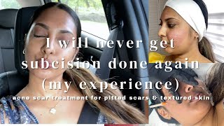 SUBCISION FOR PITTED ACNE SCARS MY EXPERIENCE I WILL NEVER DO IT AGAIN icepickrolling amp box scars [upl. by Ramsa946]