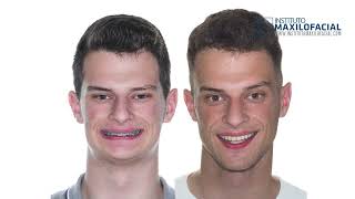 Jaw surgery Case  105 Gustavo  Short face overbite maxilomandibular retrusion [upl. by Ytissahc]